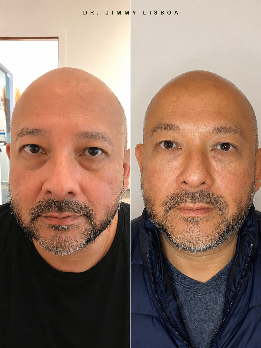 Resultado antes e depois 2